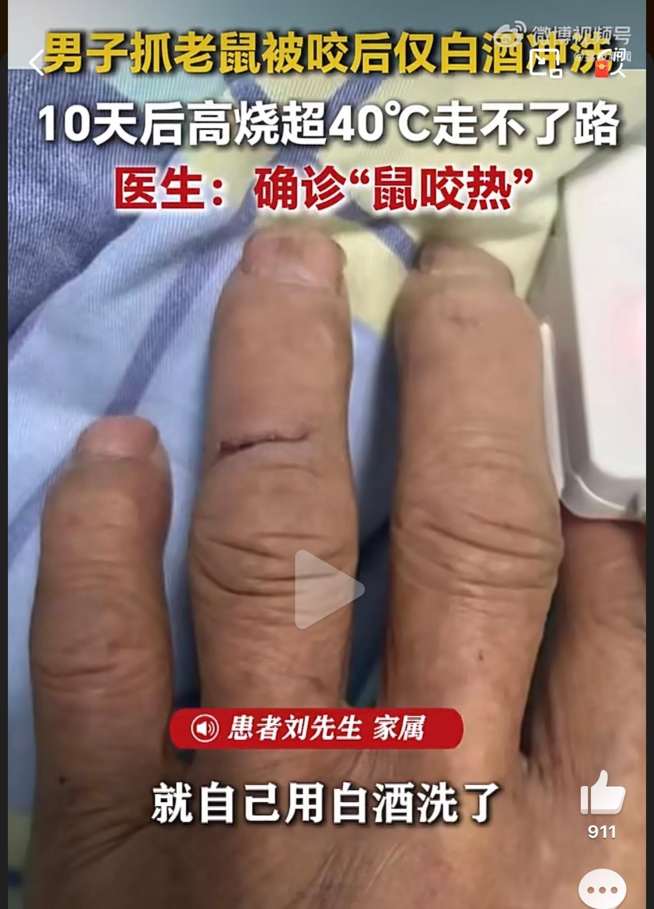 被老鼠咬10天后确诊鼠咬热老鼠不是重点，咬完不当回事才是真隐患。小伤口拖成高烧走