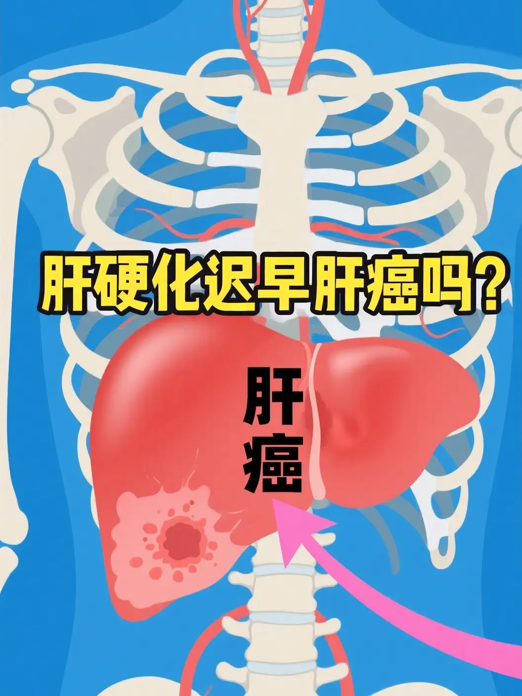 肝硬化迟早会肝癌吗？医生实话告诉你！。门诊上经常有肝硬化患者愁眉苦脸...