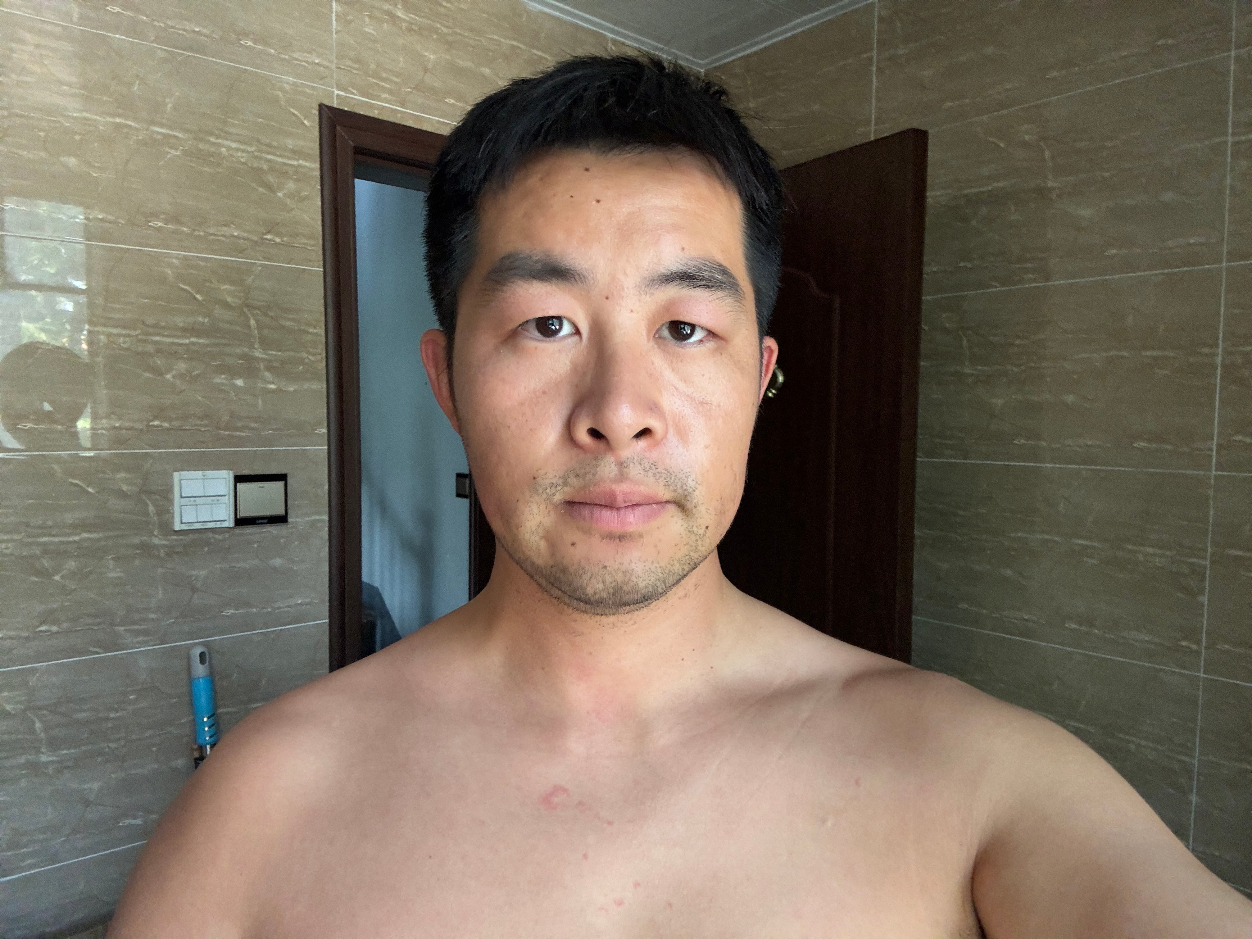 白天水肿消除一点，已经约了下午的号 ​​​