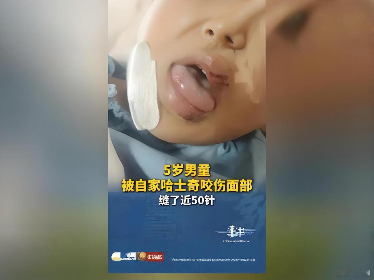 5岁男童被自家宠物狗咬毁容，面部了50针，家长悔到肠子青！
刷到这条新闻，我浑身