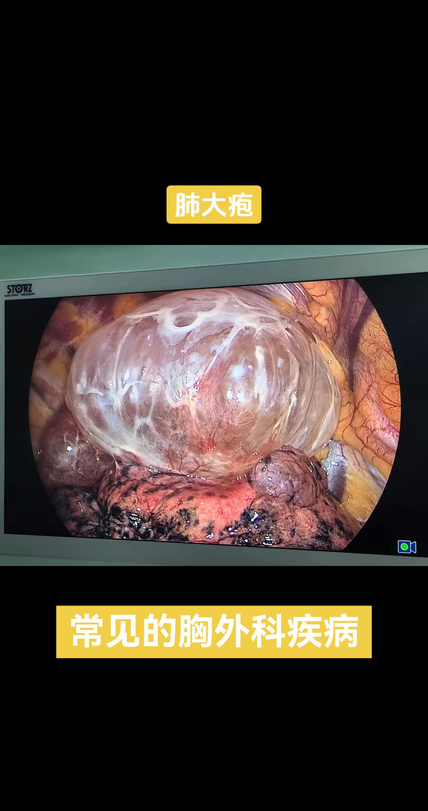 肺大疱。肺大疱(pulmonary bulla)，也叫做肺大泡，是指由...