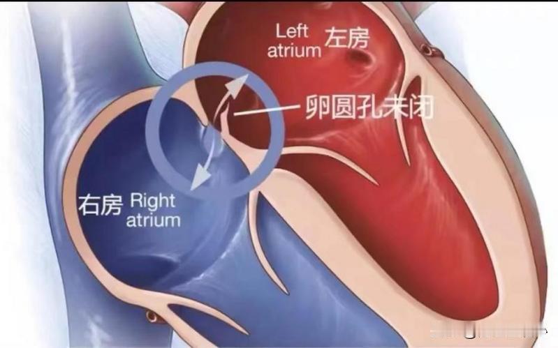 29岁女子突发心梗，心脏造影却发现血管却“干干净净”？没有狭窄也没有斑块。
提到