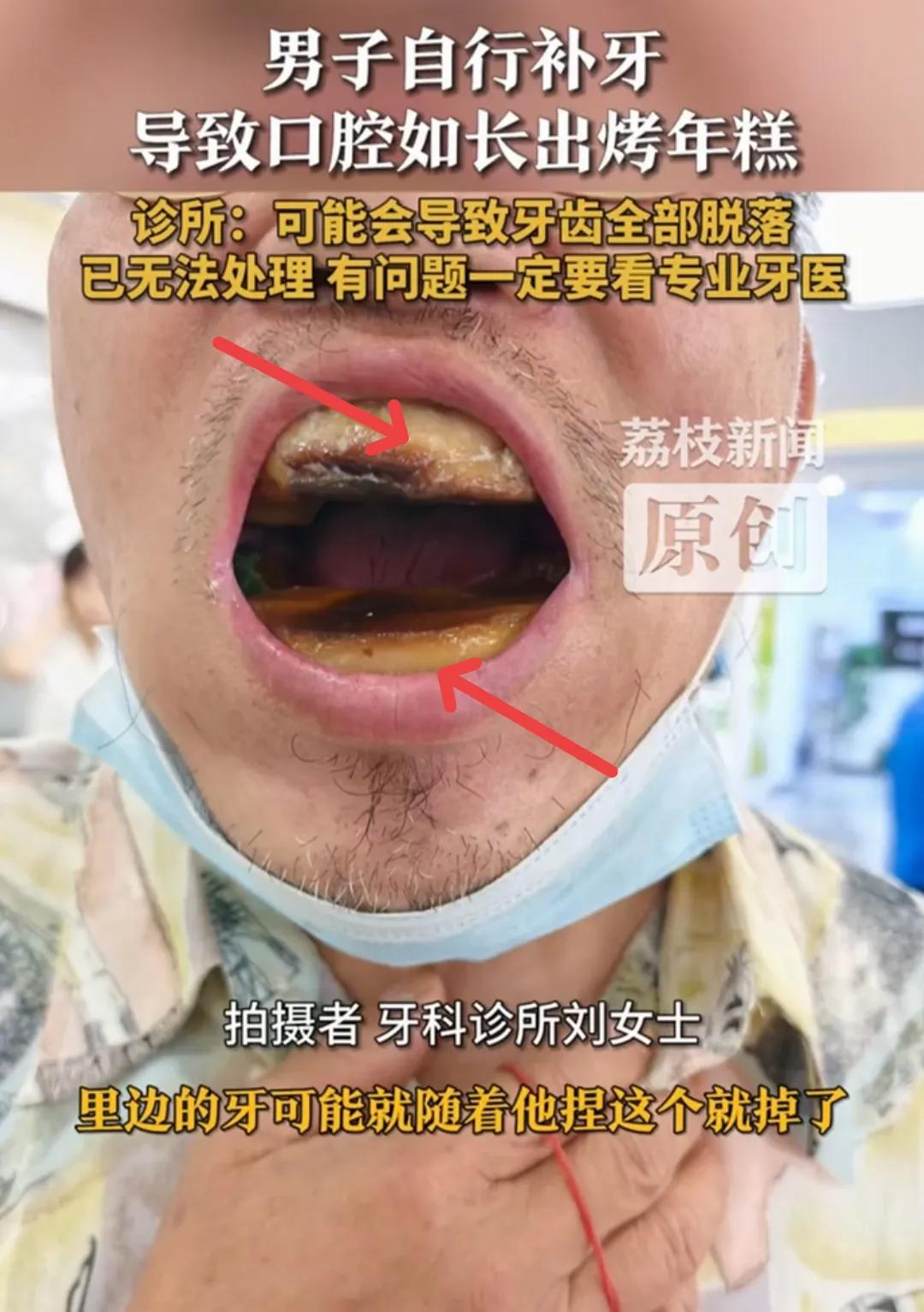 “瞎搞！”天津，一位大爷牙坏了，但是他觉得看牙太贵了，于是就花了5块钱买了材料回