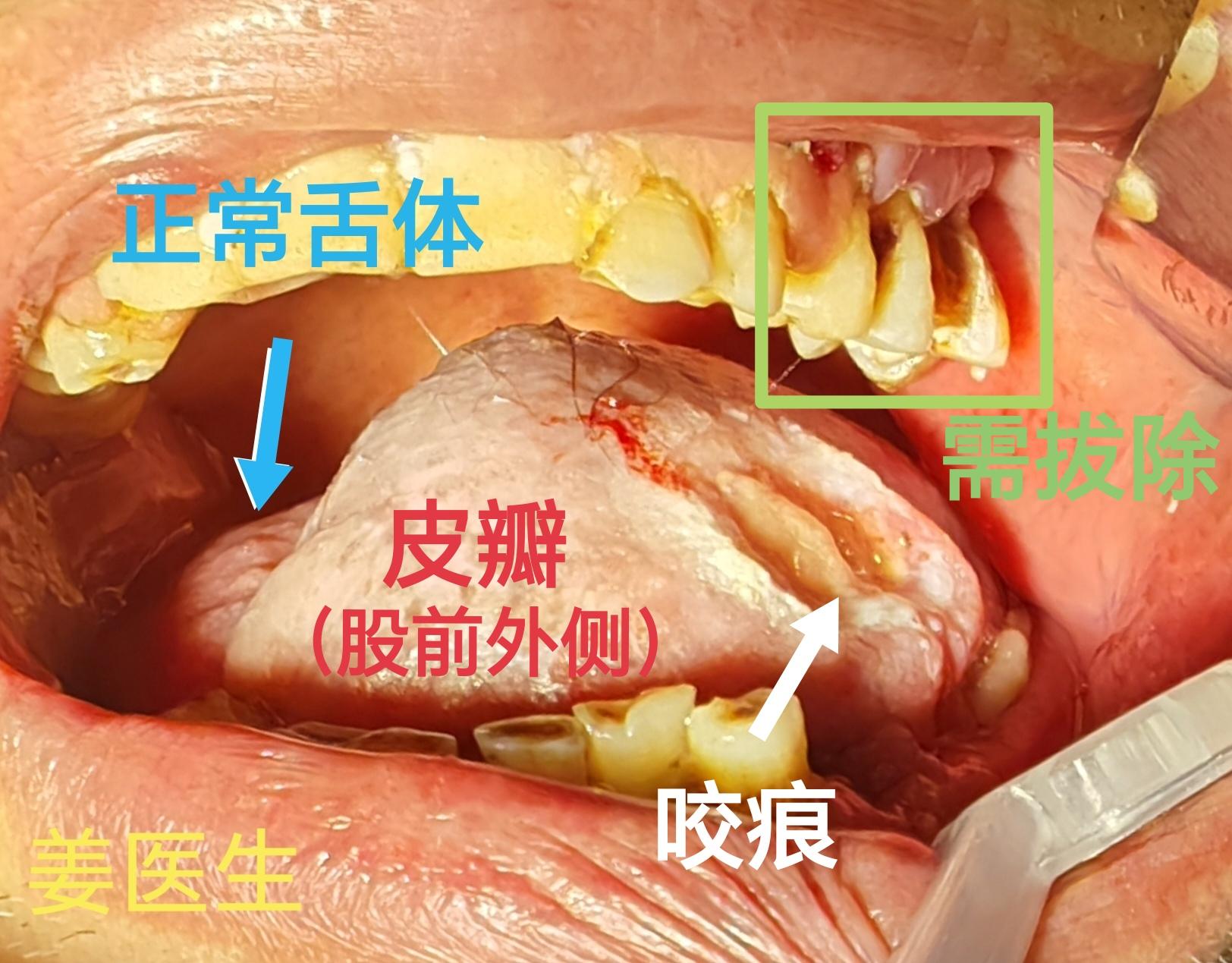 舌癌术后2月 拔牙。70+岁患者，牙齿咬伤皮瓣，拔除牙齿。