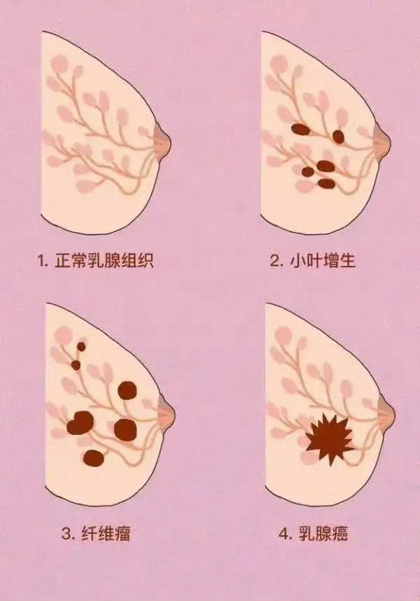 #向肿瘤说拜拜# 产生乳腺癌的原因有很多，在日常生活中，有“四种气”，最伤乳腺，