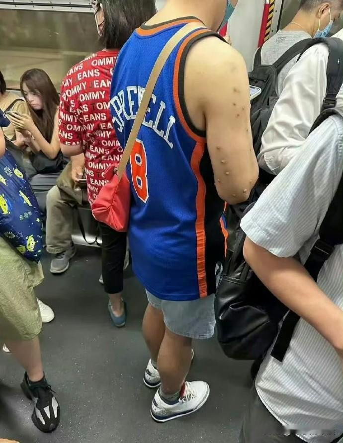 网友在香港地铁发现的怪叔叔。
这是水痘吗？就不能在家好好呆着？