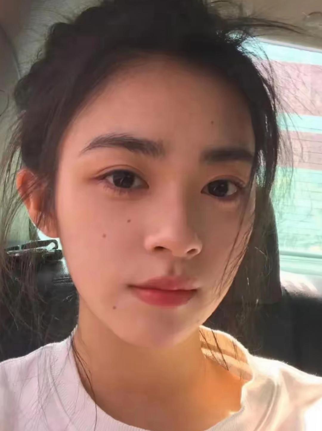 我脸上长了几颗痣，感觉好丑好丑，你们说我应该去点了吗？超纠结