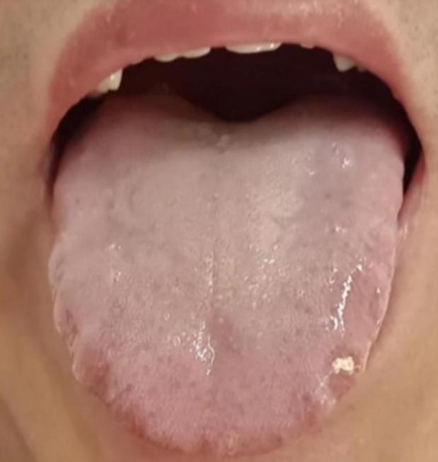 舌淡白瘦薄 + 白腻厚苔？这是阳虚兼湿！滋阴等于雪上加霜
大家好，我是中医陈大夫