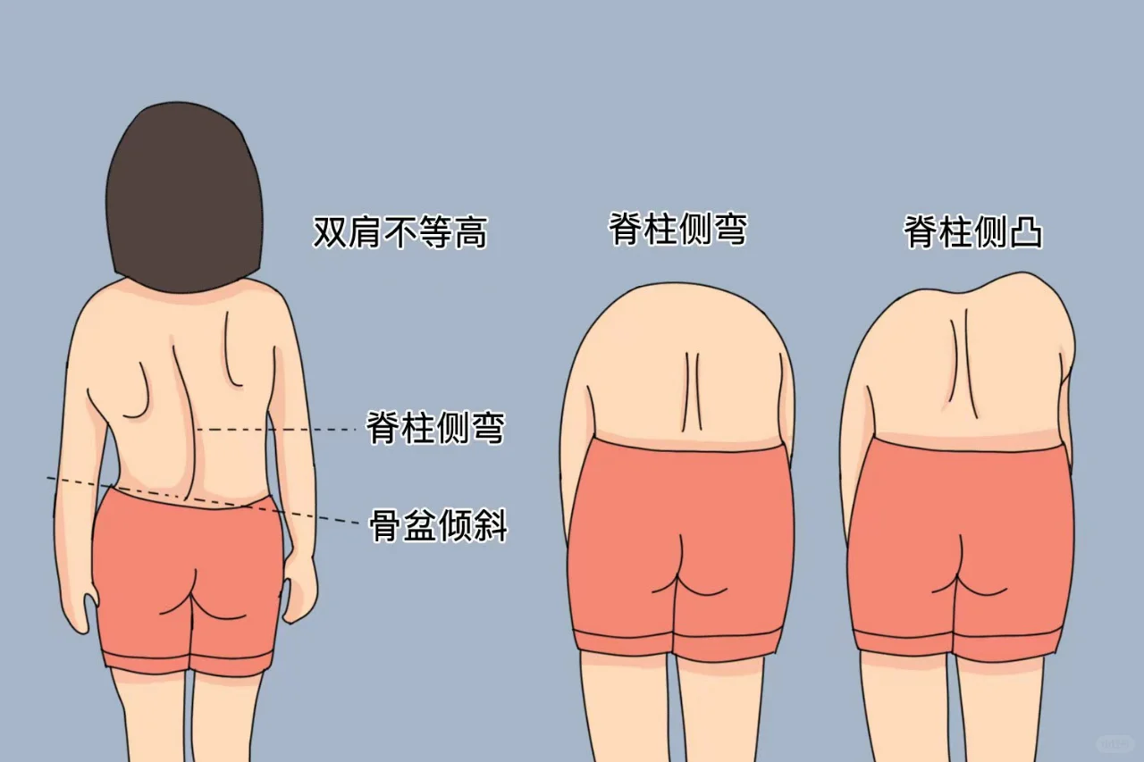 脊柱侧弯自我检测图