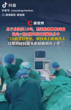 活久见！广东一男子常年鼻塞和流鼻血，去了无数次医院，医生都说是鼻窦炎，但每次治疗