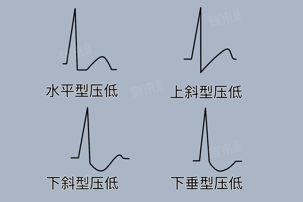 心电图说心肌缺血是什么意思?心电图顾名思义是反映心脏电活动的。在有严重的心肌缺血
