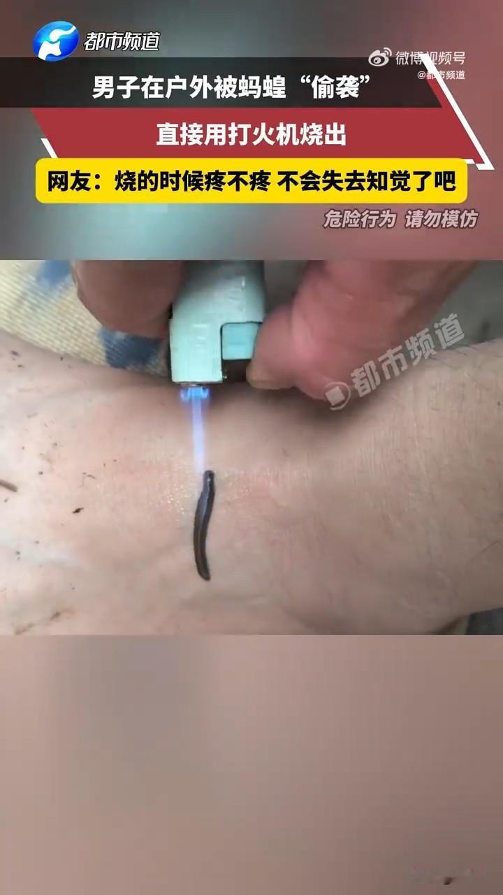 原来用火能给它直接逼出来啊，又涨知识了！

男子在户外被蚂蟥“偷袭”，钻进脚背不