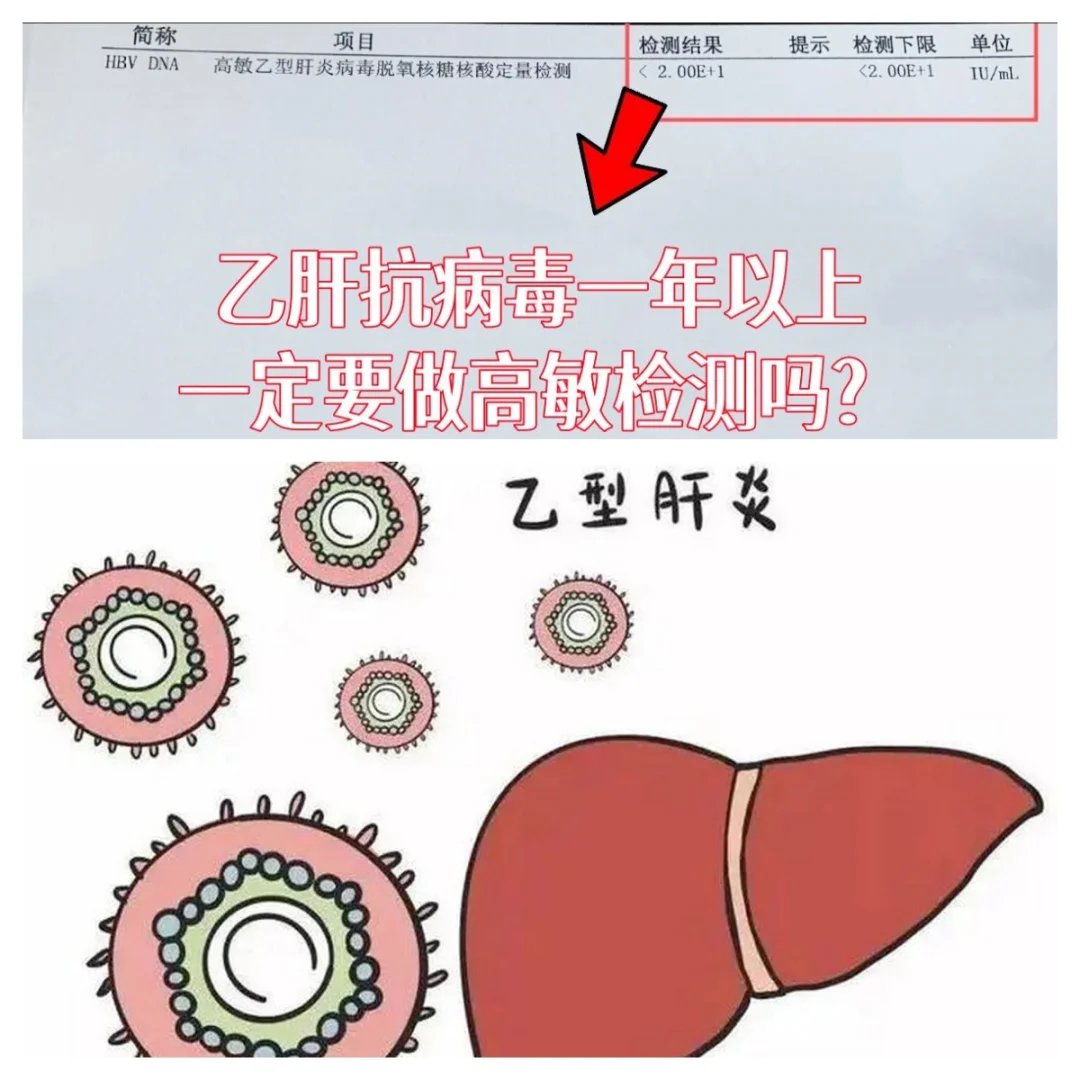 乙肝抗病毒1年以上，一定要做高敏检测吗？ 当然要做！乙肝抗病毒1年以上...