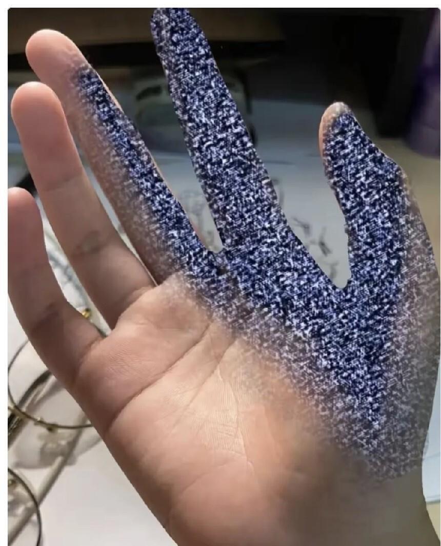 右手麻了六年，一直当成颈椎病治，前前后后花了十万多，结果上个月陪人去拿体检报告，