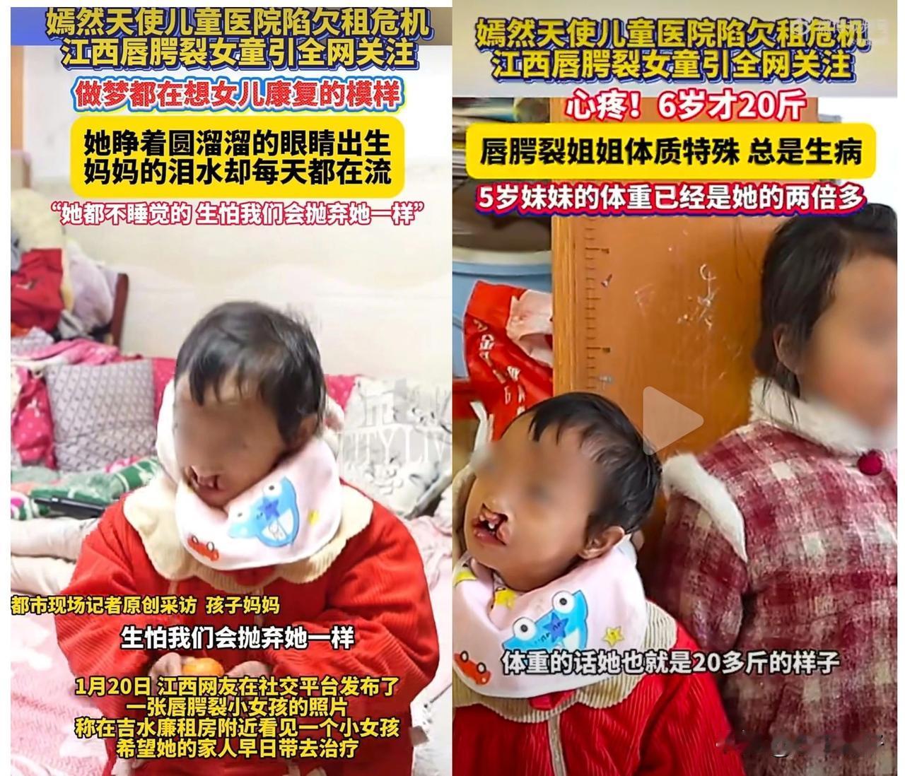近日，一则关于江西吉水一位6岁唇腭裂患儿的报道牵动人心。这是我见过最严重的一例唇