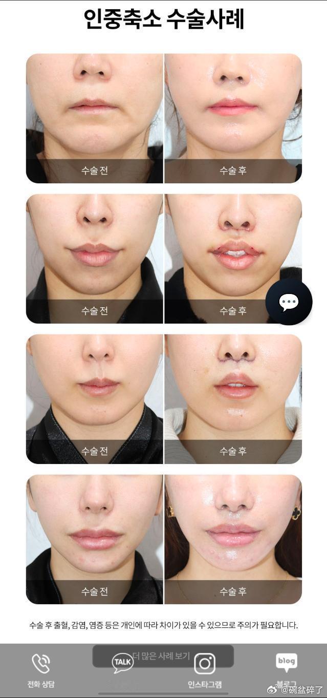 人中缩短在韩国属于很成熟的项目，但做得细不细、效果自不自然，差别还挺大的，毕竟人