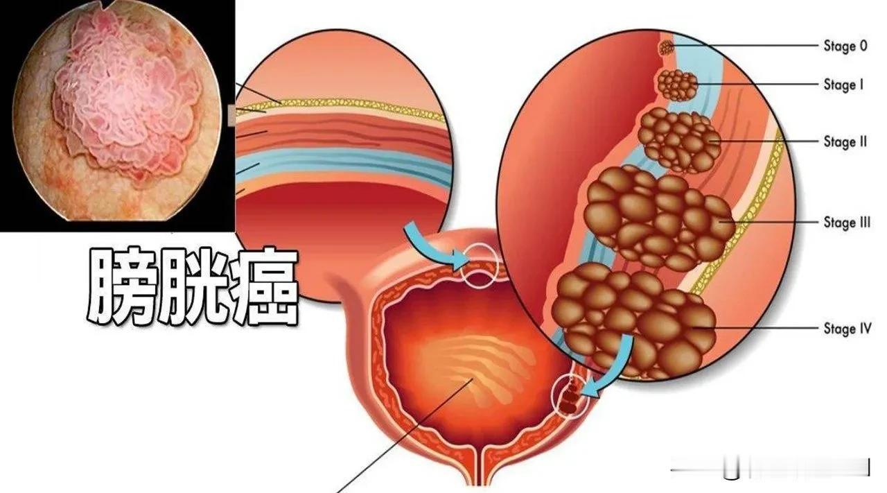 惊！膀胱有癌，尿尿竟能先知？这种排尿习惯让你患癌几率暴增5倍！

膀胱，这个我们