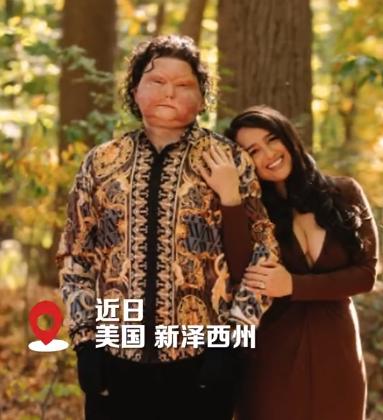 全球第一个成功换脸的男子宣布订婚，婚礼即将在12月份举行。
2018年的时候，美