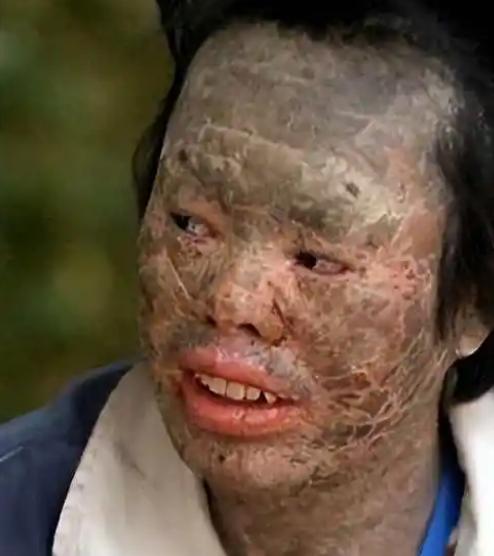 吃蛇太多变蛇人？辽宁村民韩永波爱吃蛇，吃了多年没出事，直到一条黄花松蛇下肚，皮肤