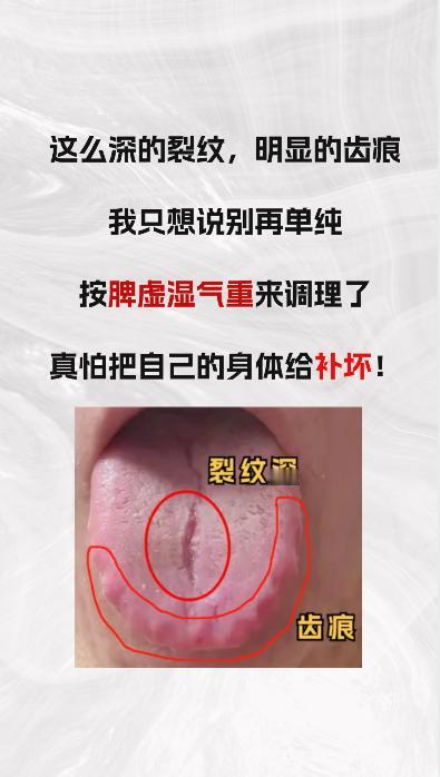 如此明显的裂纹和齿痕，但也不要健脾祛湿 ，真怕你把身体搞坏
#中医#