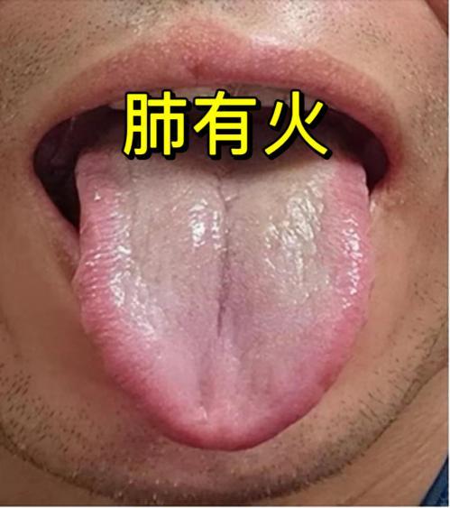 大家好，我是中医陈大夫！最近不少朋友总被咳嗽缠上，喉咙肿痛、咳出来的痰又黄又黏，