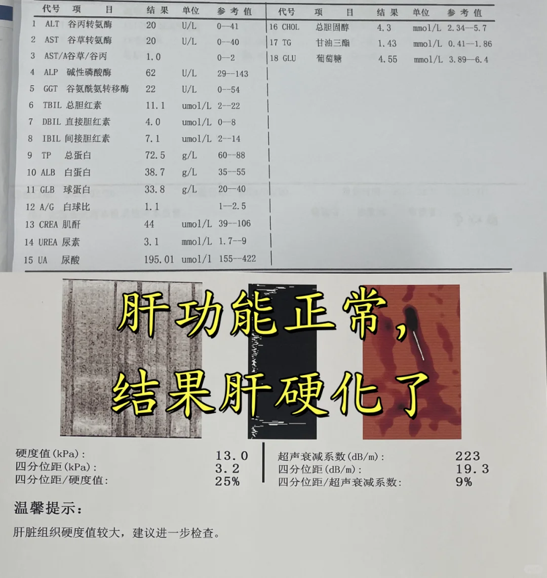 肝功能正常就是肝脏正常吗？ 当然不是！大家看这两张报告单，肝功能虽然正...