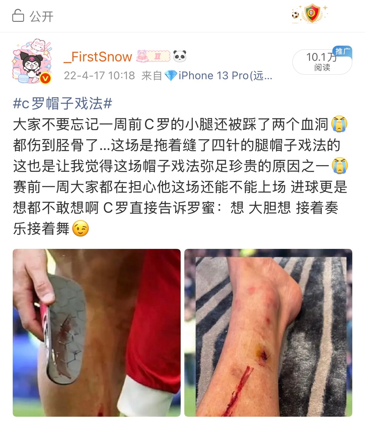 to新粉们的真·“连心疼你都有时差”环节来了想说抬二这个血洞远比想象中严重很多 