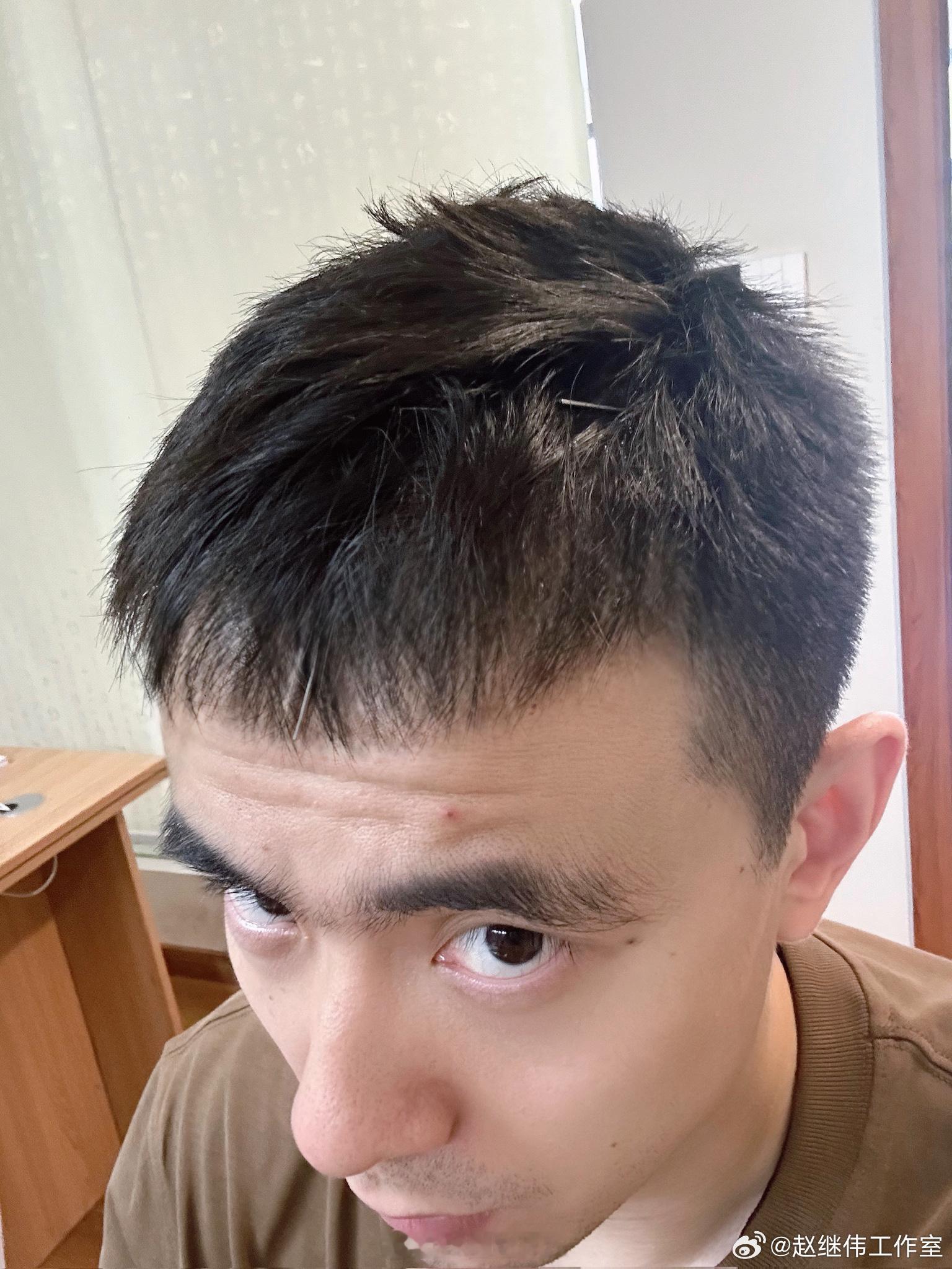 赵继伟进入嗓子治疗下一阶段，他的头和喉咙都进行了针灸。cba ​​​