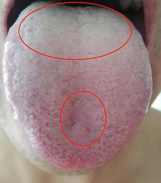 舌面凹陷为虚，凸起为实！
 
患者舌根凸起，还有白腻苔，说明有寒湿郁积了，而舌前