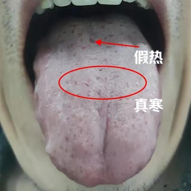舌诊分析：心脉瘀滞不通，真寒假热之象
1、“舌尖暗紫，有瘀点”——舌尖反映心和肺