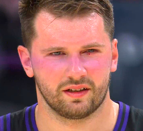 ▲东契奇左眼这边挂彩了