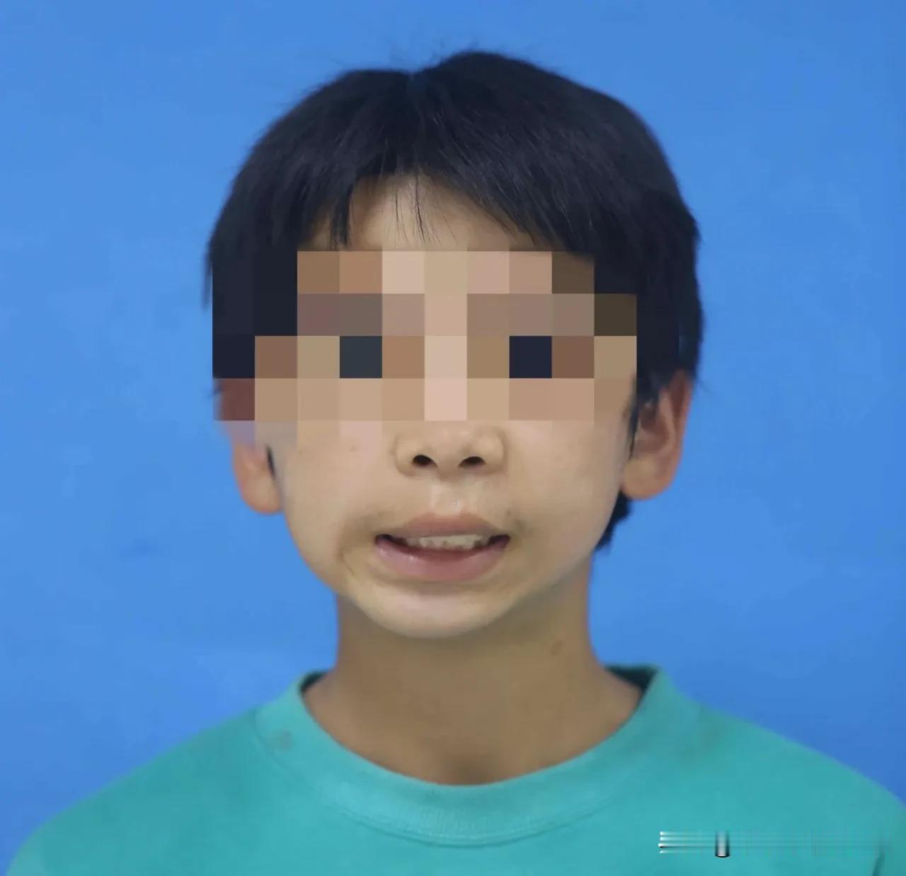 宁夏医科大学为14岁男孩靠3D打印重建下颌！#春日生活打卡季#
8年前，小田（化