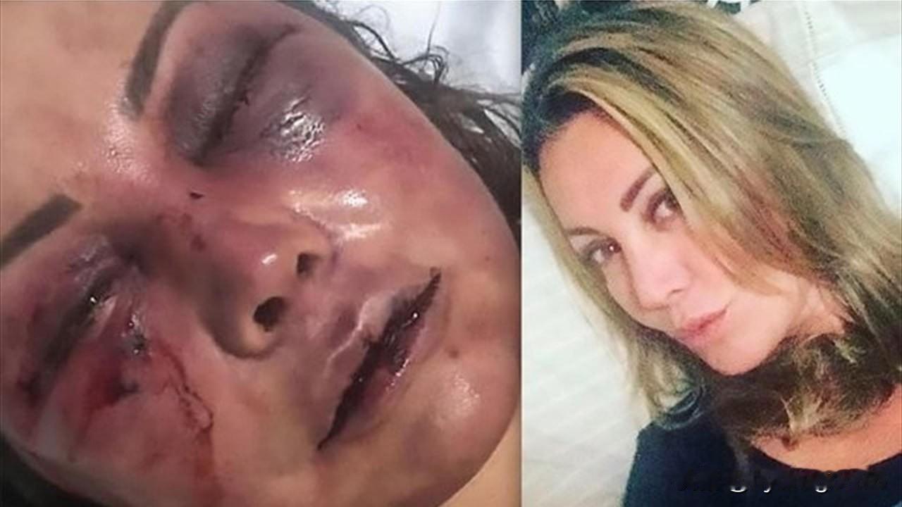 🇷🇺🇺🇦一名身负重伤的22岁女孩从乌克兰的囚禁中逃脱，进入俄罗斯境内。