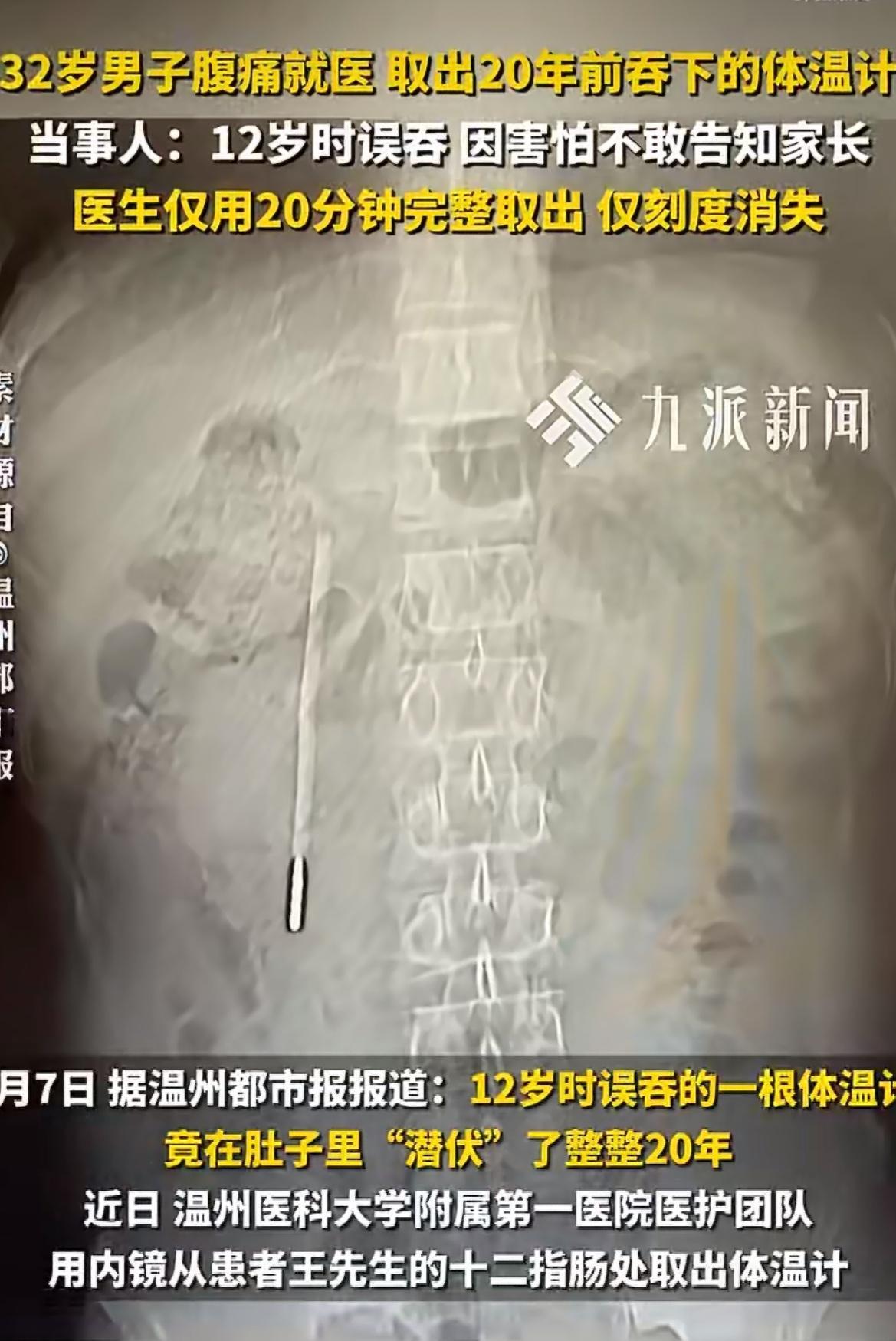 命真大啊！32岁男子腹痛就医，医生竟从他肚子里取出12岁吞下的体温计！当年害怕被