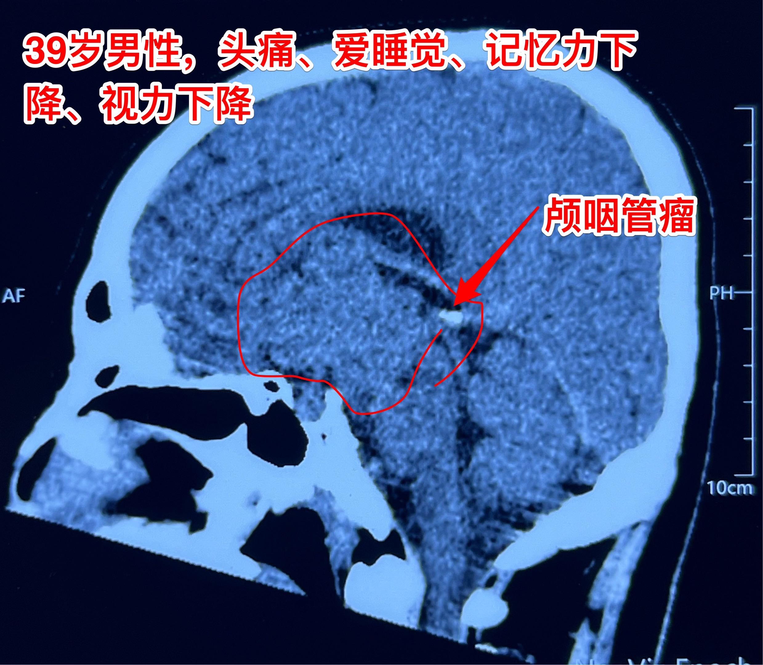 巨大的乳头型颅咽管瘤。39岁黑龙江男性，病史一年余，症状为：头痛、乏力...