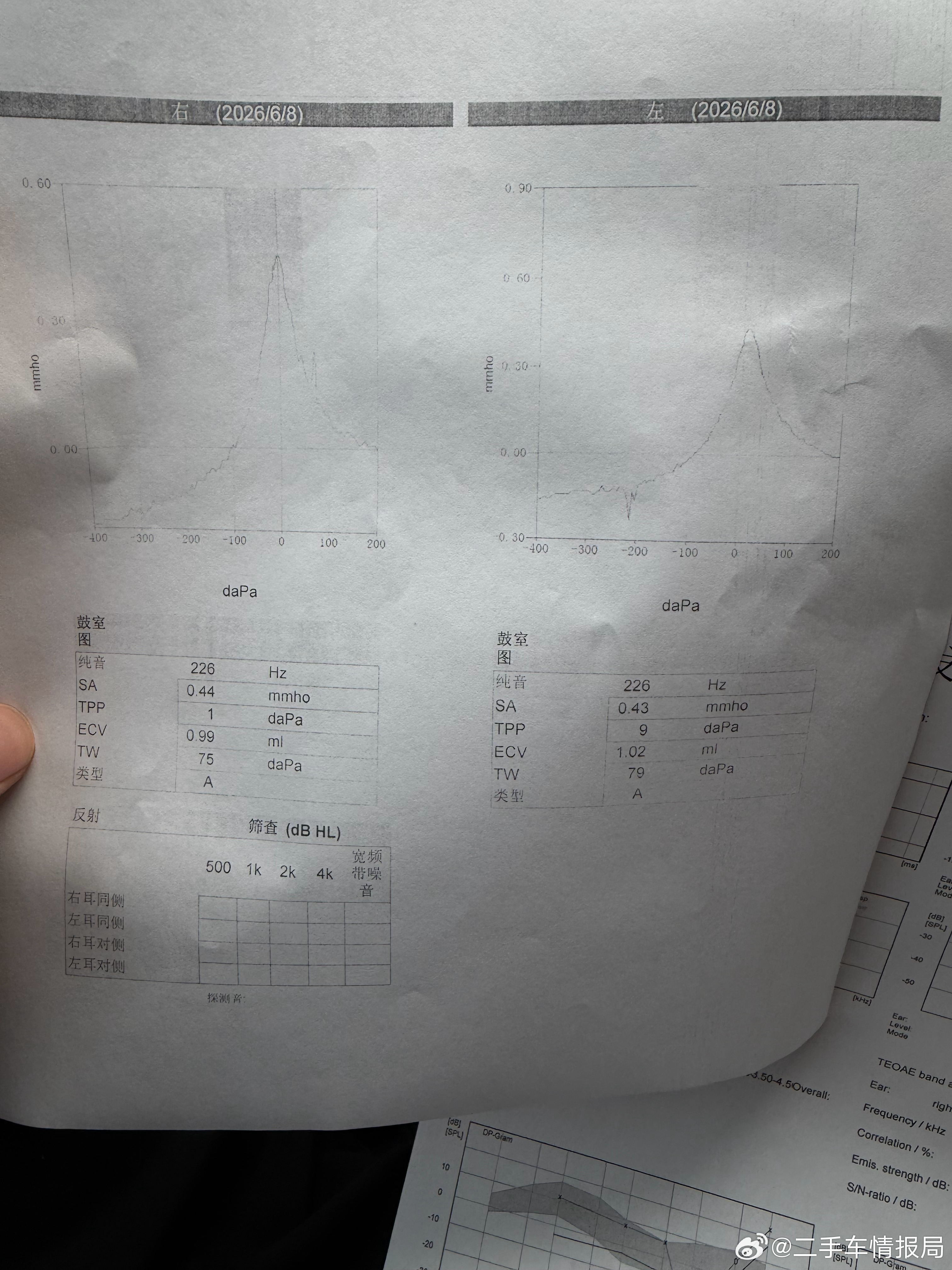 没有堵塞，中耳也测了耳声发射检测确实是4000hz有下降两耳都是，但是我右耳没感