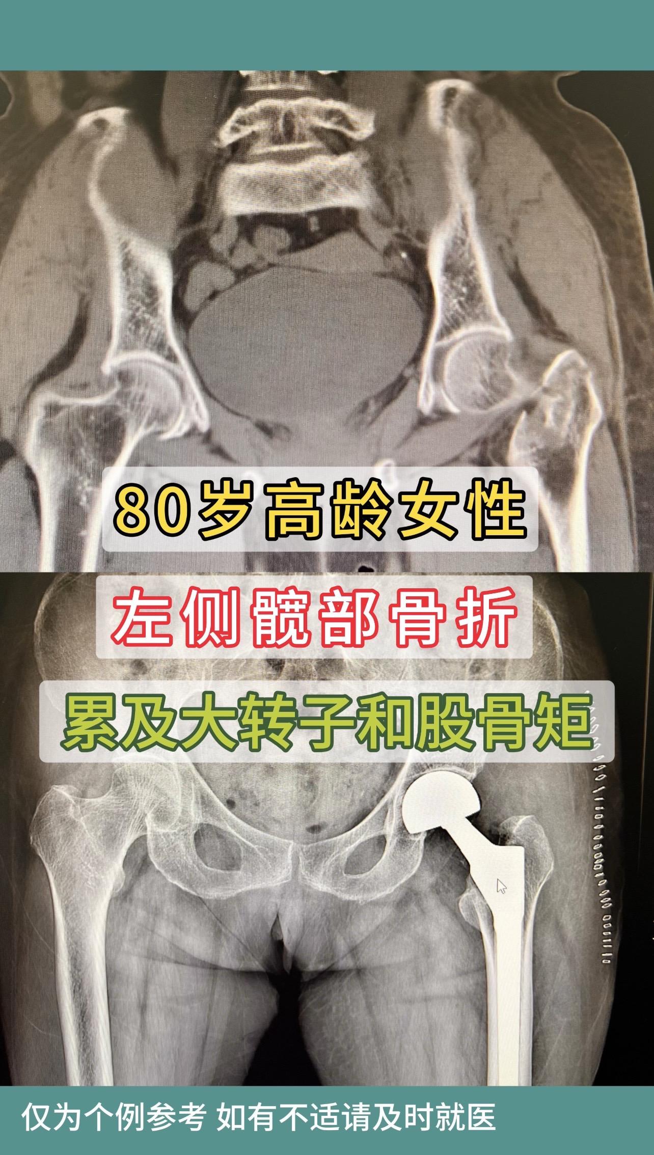 80多岁女性，左侧髋部骨折累及大转子和股骨矩。患者1周前急性脑梗。与家...