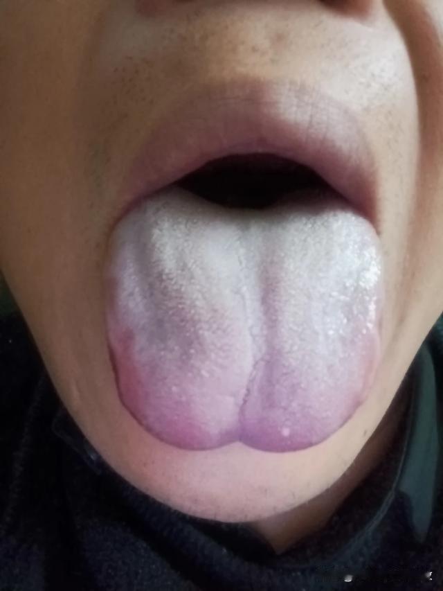 舌面没一点血色，舌尖下凹，这舌头真让人头疼[晕][晕][晕]
粉丝反馈呢：气喘乏