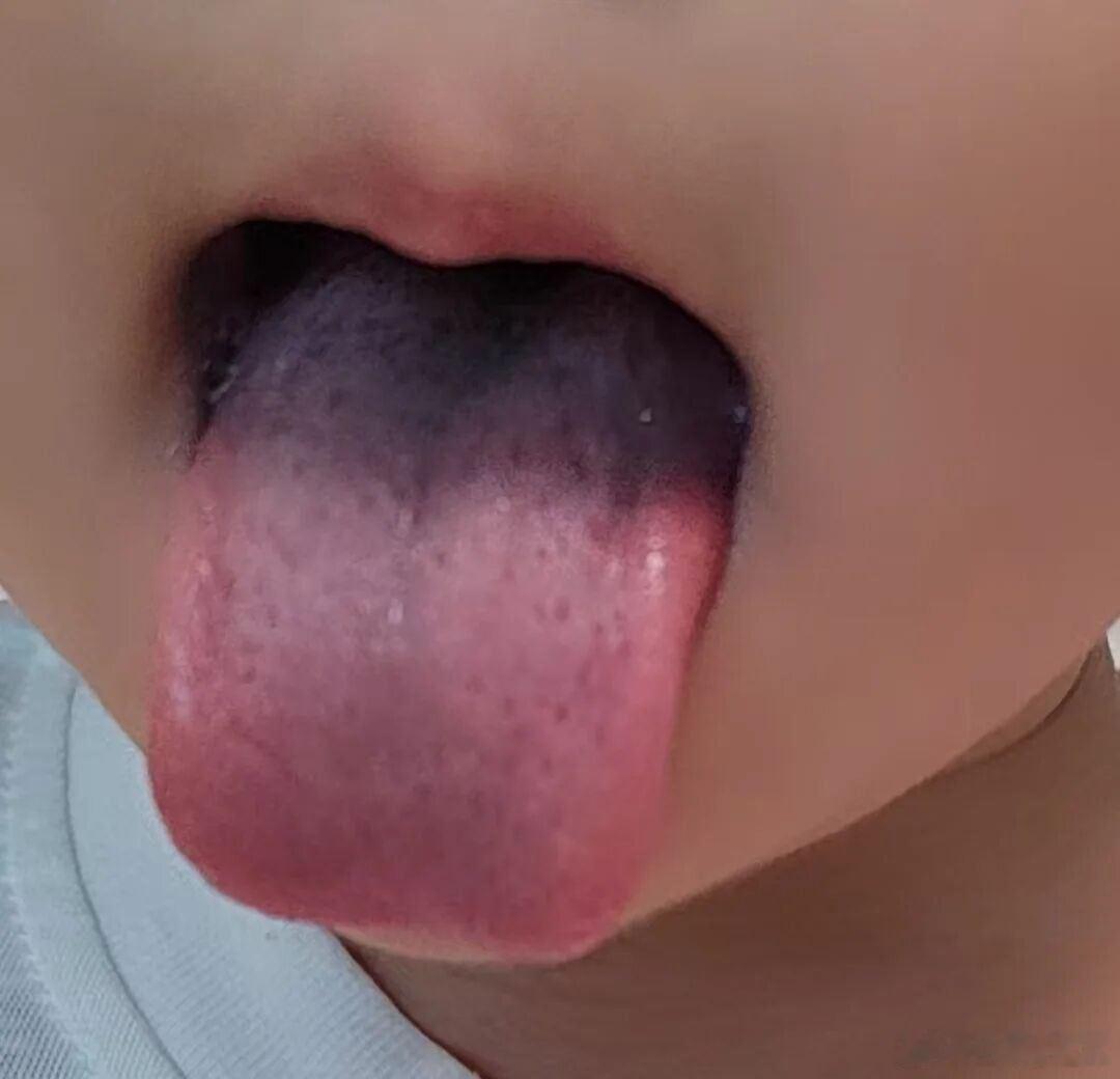 睡觉流口水｜脾虚失摄，地仓固津脾开窍于口，在液为涎。口水即是脾所主之涎液。清醒之