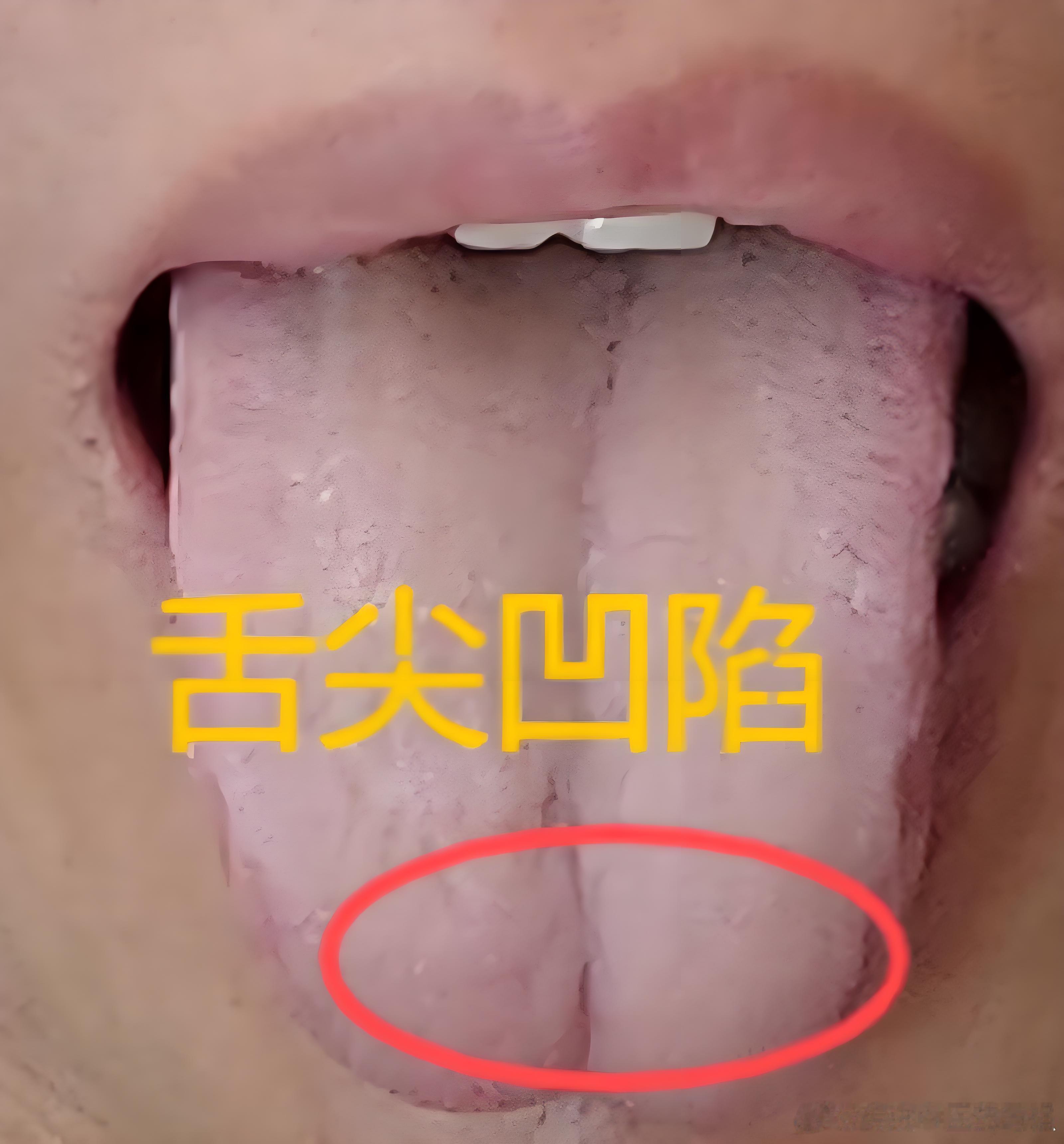 舌尖凹陷的程度，往往与上焦心肺虚损的程度成正比。凹陷越深、越明显，说明心气、心阳