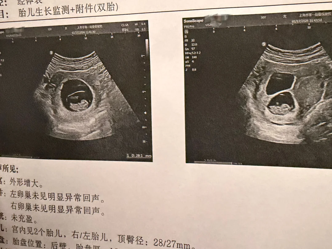 一妇婴B超，单胎变双胎