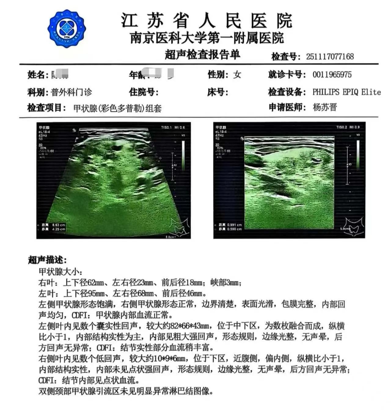 甲状腺囊肿，经一个月治疗，
已经缩小一半啦～～
（梅花独秀医生）
散甲状腺结节 