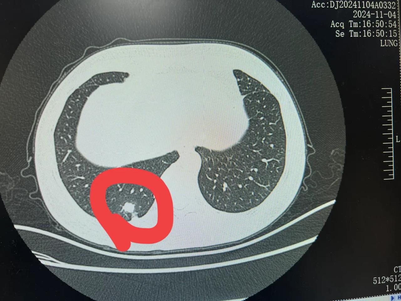 女性，47岁，国企在职工人，体检胸部ct发现右下肺一14毫米的实性结节，伴胸膜牵