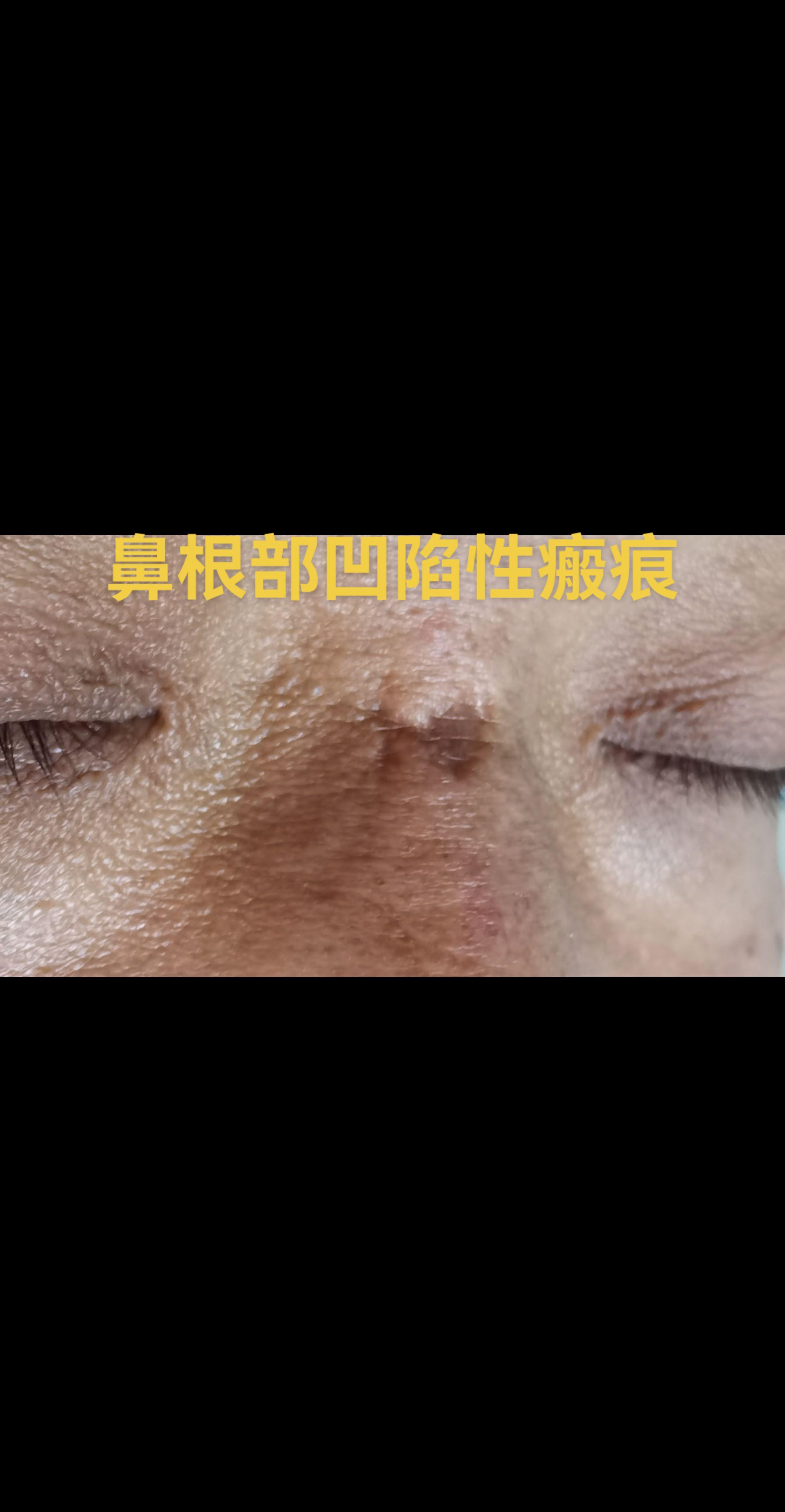 鼻根部瘢痕。