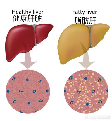 容易伤肝的行为有哪些全国爱肝日全民健康生活养成计划 长期熬夜真的会伤肝吗？为什么