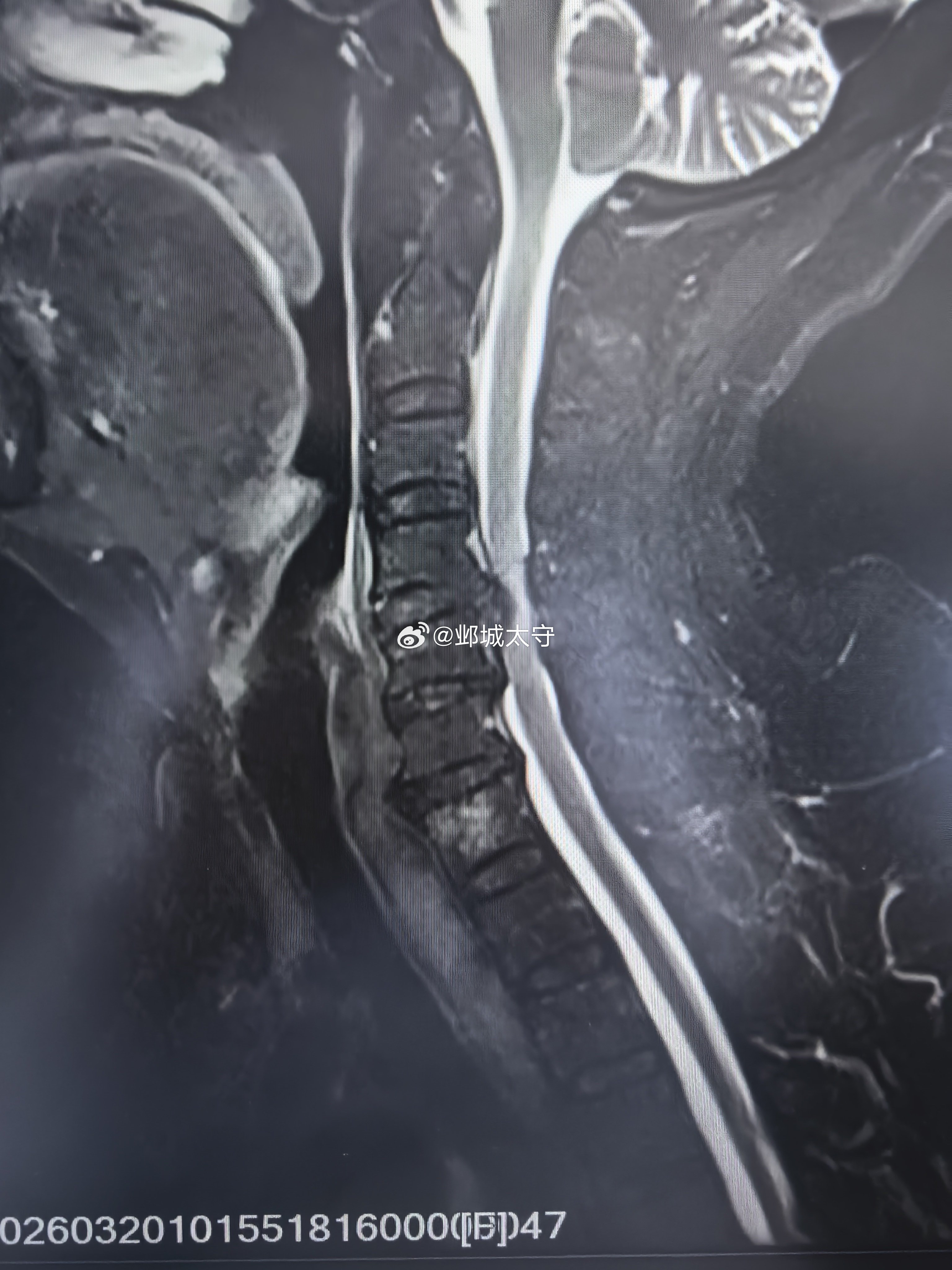 患者上午下地干活儿时突然四肢不能动了，查体四肢瘫，肢体躯干伴有麻木，考虑急性颈髓