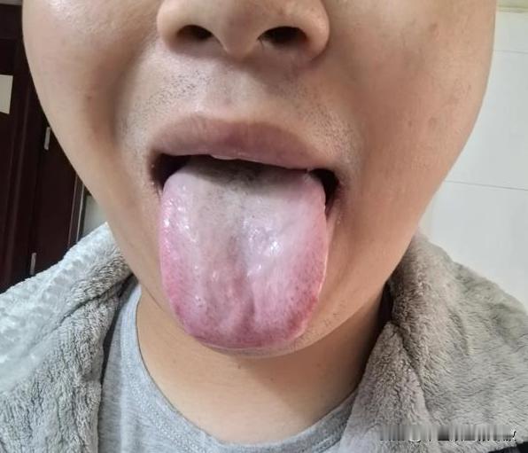遇上这种舌头，10个男的，9个男科都有问题，不信的话你看你自己的[捂脸][捂脸]