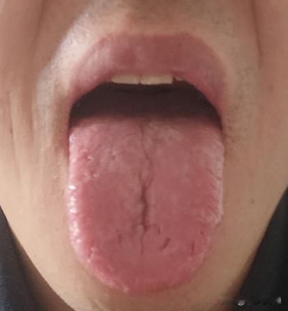 又是一个裂纹舌，一看就是年轻不在意，可劲儿造，亏虚成这样；

舌象分析：

气虚