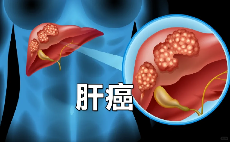 原发性肝癌诊疗指南2024版摘选肝癌穿刺活检