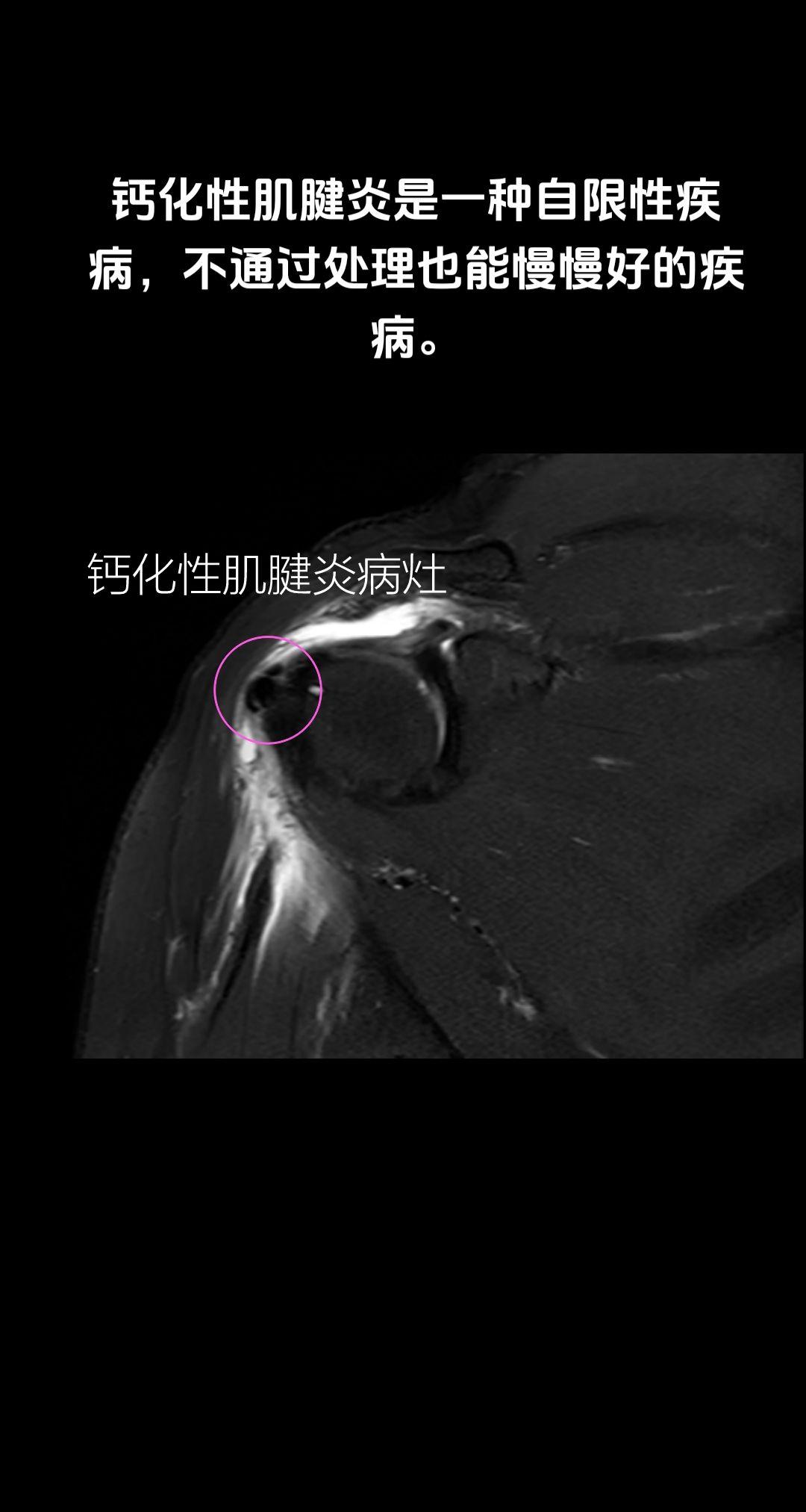 自限性疾病~钙化性肌腱炎。